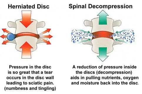 Chiropractic Westerly RI Spinal Decompression